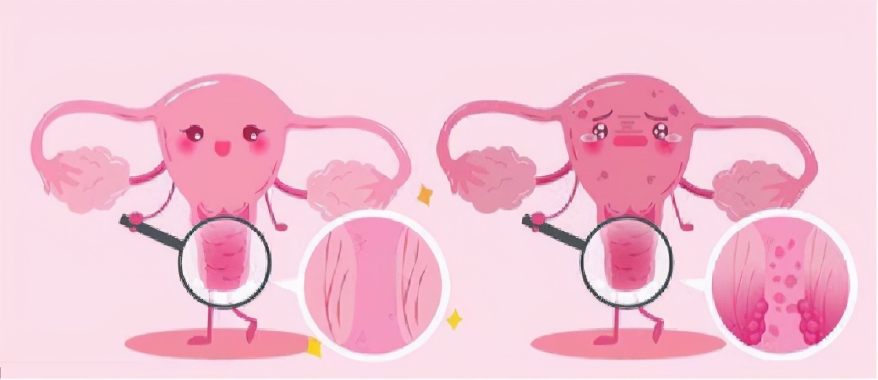 女性腿疼是宫颈癌的早期预兆吗,宫颈癌晚期腿肿腿痛还能活多久