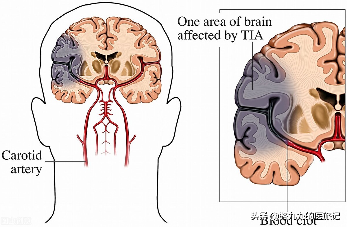 64岁老太急性脑梗，失语偏瘫紧急救治静脉溶栓，1小时后痊愈