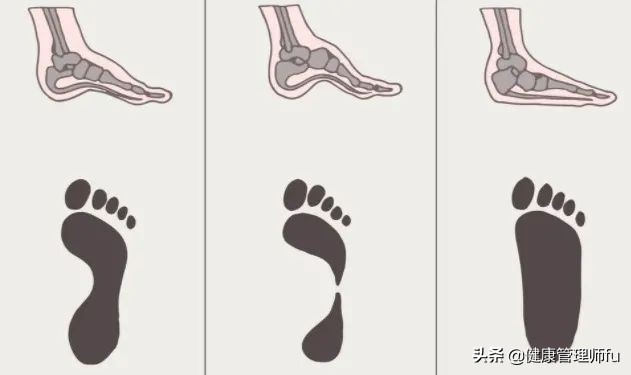 有人容易崴脚,护踝真的可以预防崴脚吗