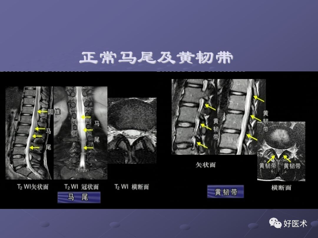 脊柱mri有哪些特点,乳腺疾病的mri诊断及鉴别