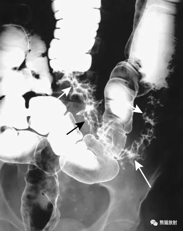 腹部影像图片大全,乙状直肠疼痛位置图片