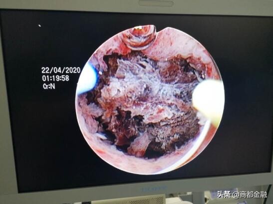 胎盘植入介入手术全过程妇产科,胎盘植入介入手术成功率高吗