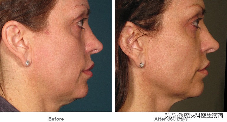 祛斑祛红色痘印激光,点阵激光祛斑仪器