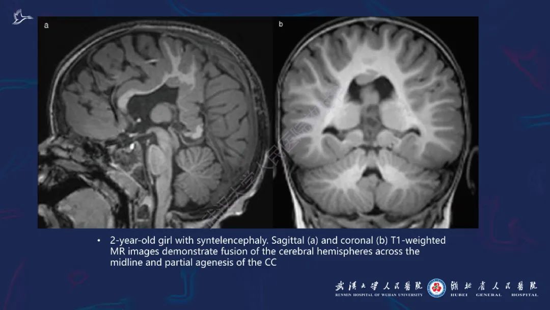 胼胝体肿瘤影像鉴别,胼胝体病变影像诊断