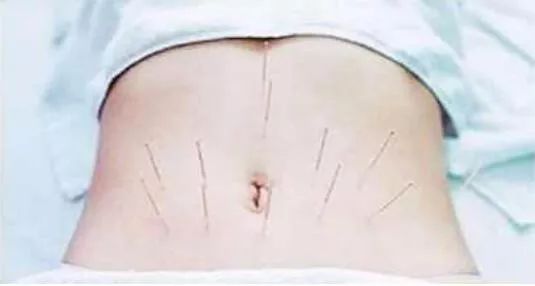 产后腹胀的处理方法,产后肚子胀气热敷用什么药材