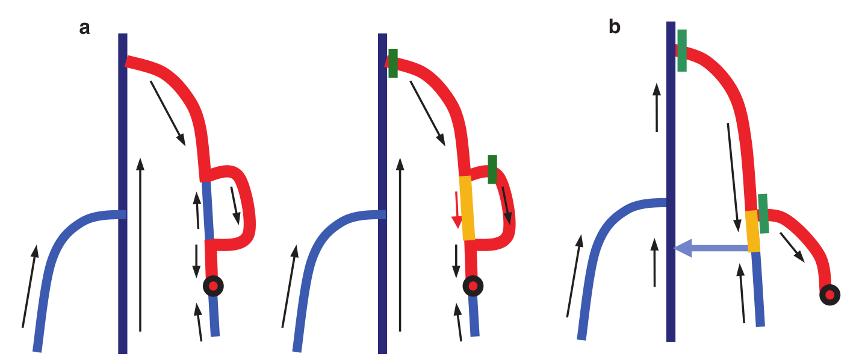 chiva治疗下肢静脉曲张价格,chiva治疗静脉曲张