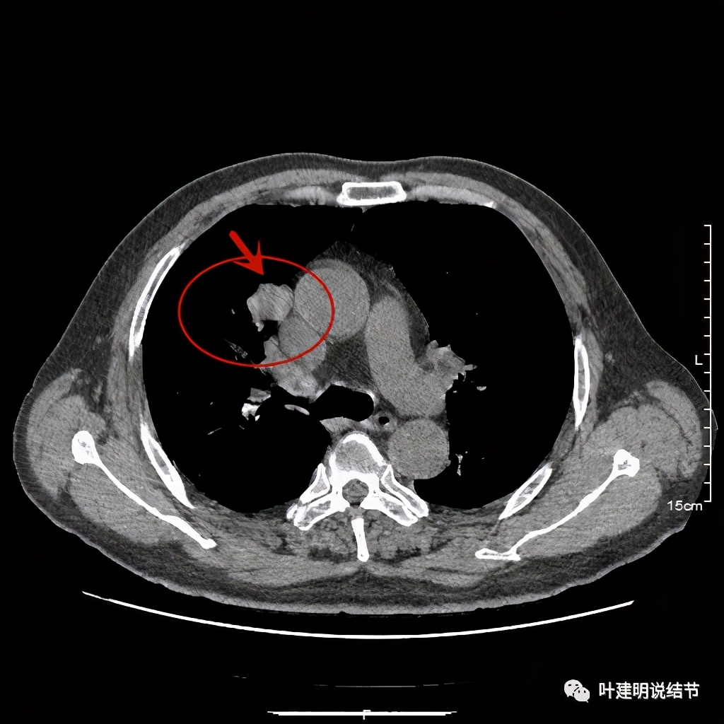 误诊报告图片,误诊案例及案例分析