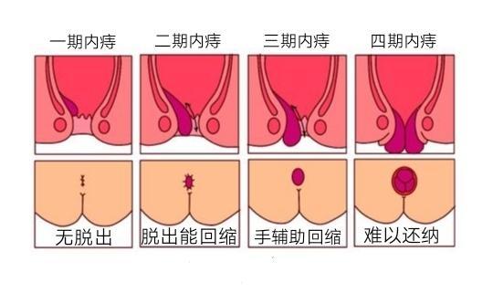 哪些疾病会导致痔疮发作,劳累过度会引起痔疮复发吗