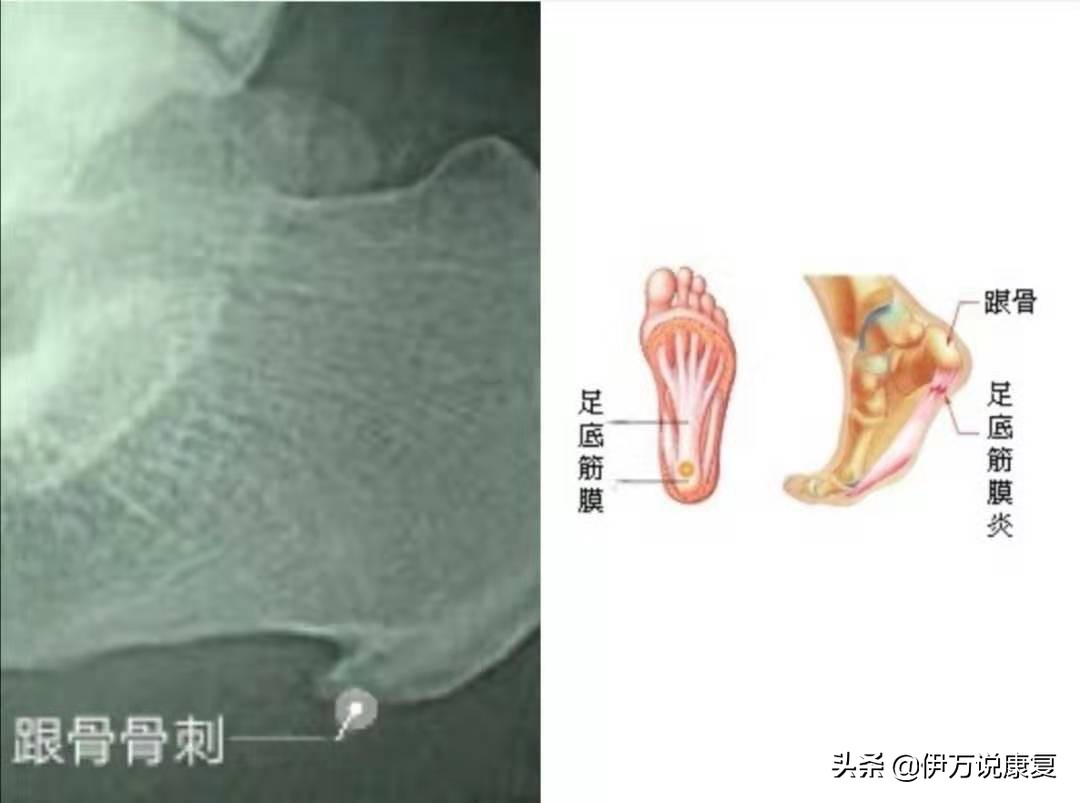 三个步骤改善足底筋膜炎,足底筋膜炎的自我治疗图解