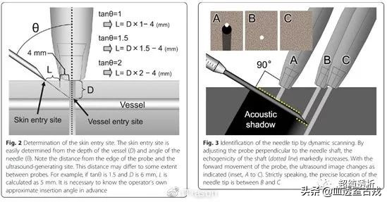 超声引导下血管穿刺效果评价,超声引导下血管穿刺置管流程