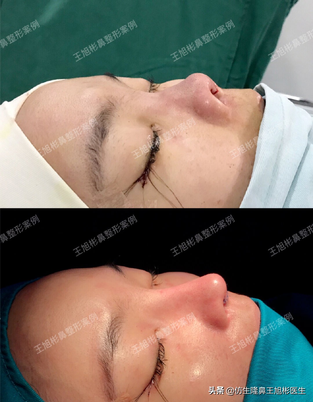 短鼻延长的最佳方法,短鼻修复前后对比案例