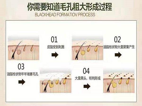 去黑头收缩毛孔的简单小方法,去黑头收缩毛孔简单小方法