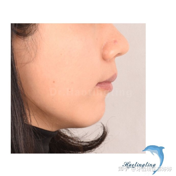 上海成人牙齿矫正失败案例,上海牙齿矫正郝婷婷医生