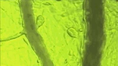 冠脉狭窄30为什么胸痛,冠心病没有冠脉狭窄胸痛