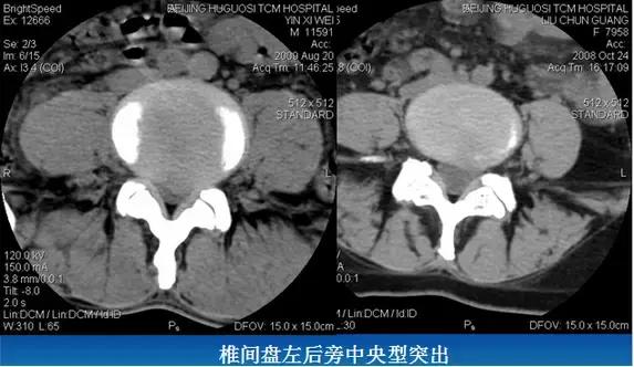 腰椎退行性变腰椎间盘轻度突出,椎间盘突出并膨出继发椎管狭窄
