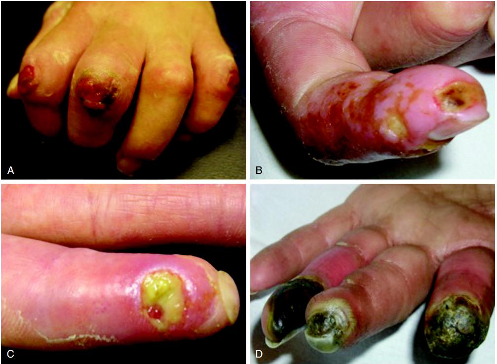 系统性硬化症/硬皮病是什么样的疾病?