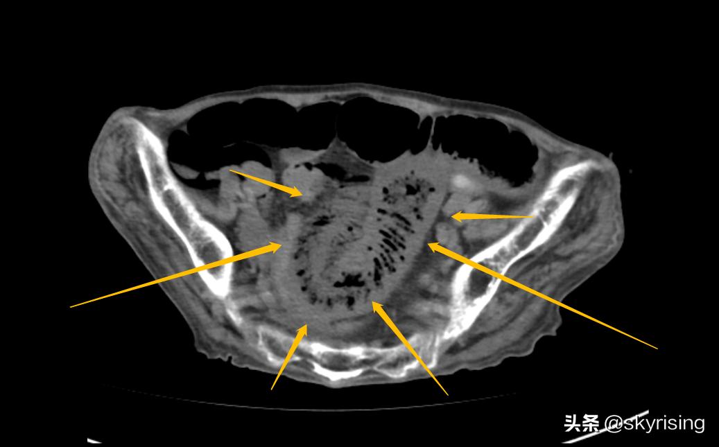 老人术后并发症,老年人术后风险有哪些