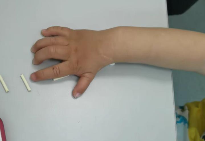 拇指多指手术后怎么护理,拇指漂浮指治疗康复案例