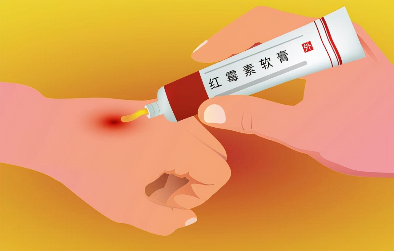 红霉素软膏下面肿可以涂吗,红霉素在眼部涂两下有什么效果