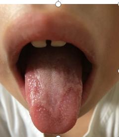 地图舌靠小儿推拿可以治好吗,小儿地图舌治疗怎么推拿