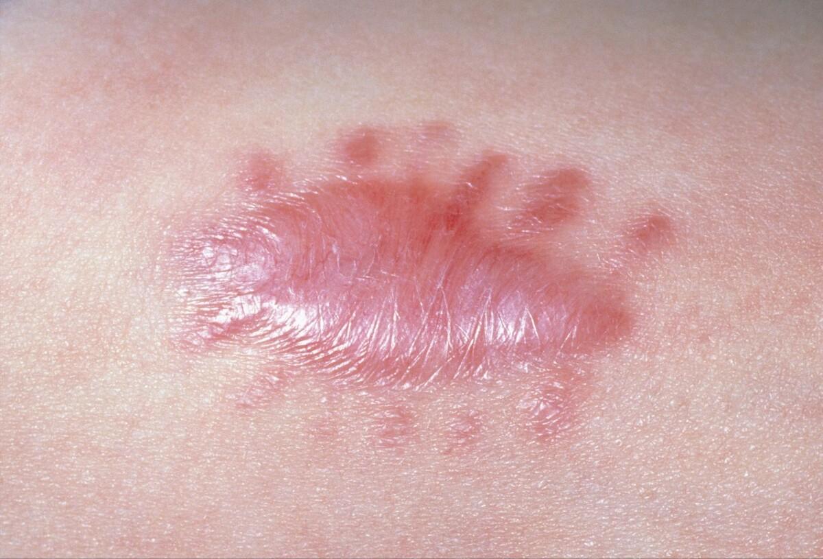 宝宝蚊子叮咬疤痕怎么去除,蚊子叮咬用手抓破后伤好后有疤痕