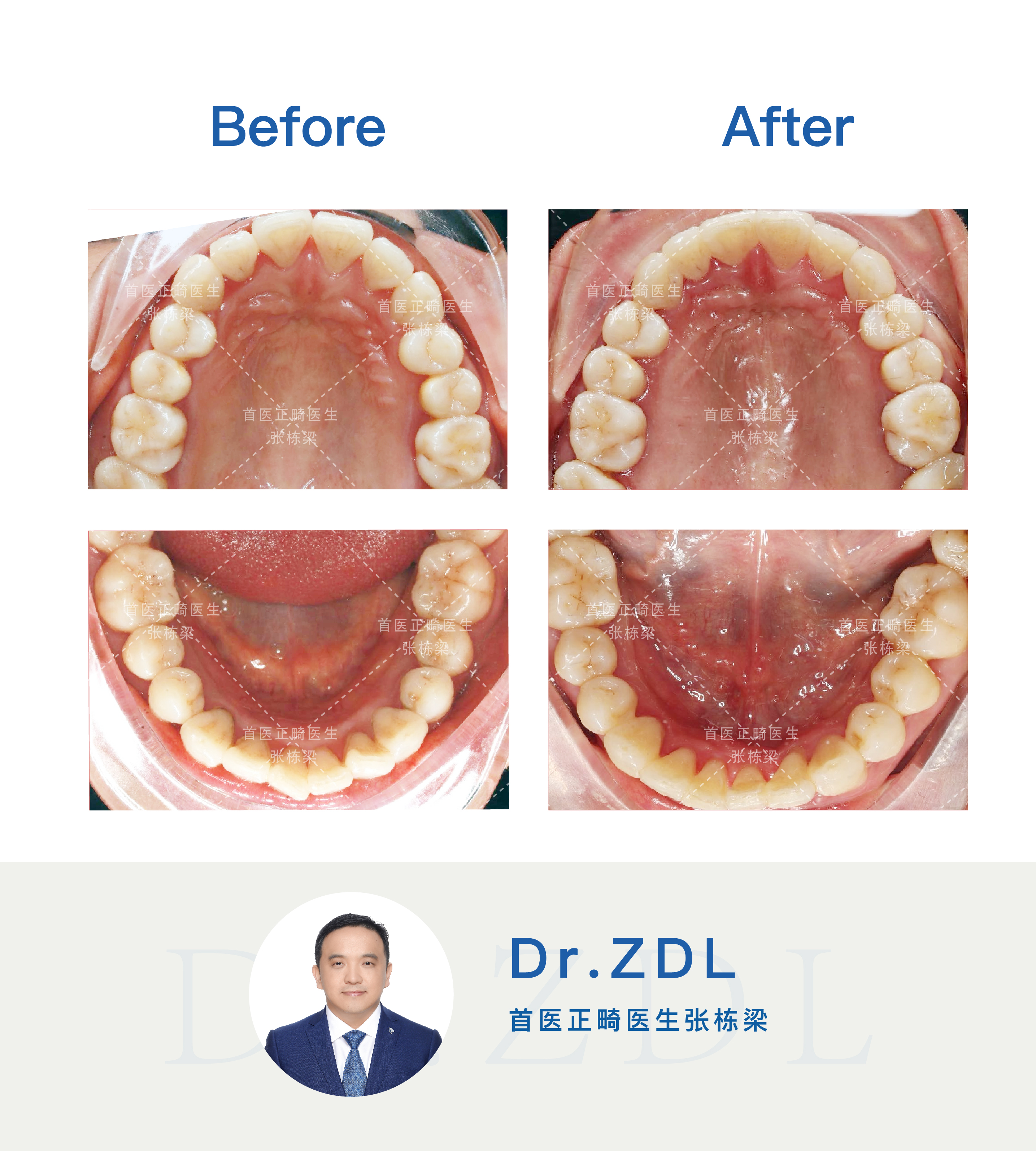 嘴突不做牙齿矫正后果,嘴突没有龅牙可以修复吗