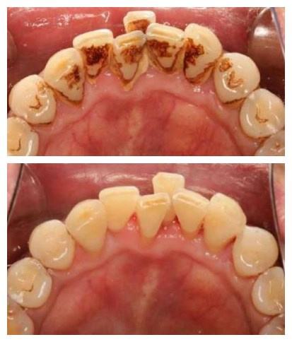洗牙多长时间洗一回,洗牙多长时间洗一次牙垢
