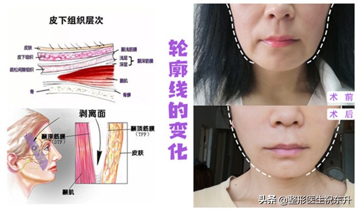法令纹怎么去除男生不会有副作用,去除法令纹最安全有效的方法