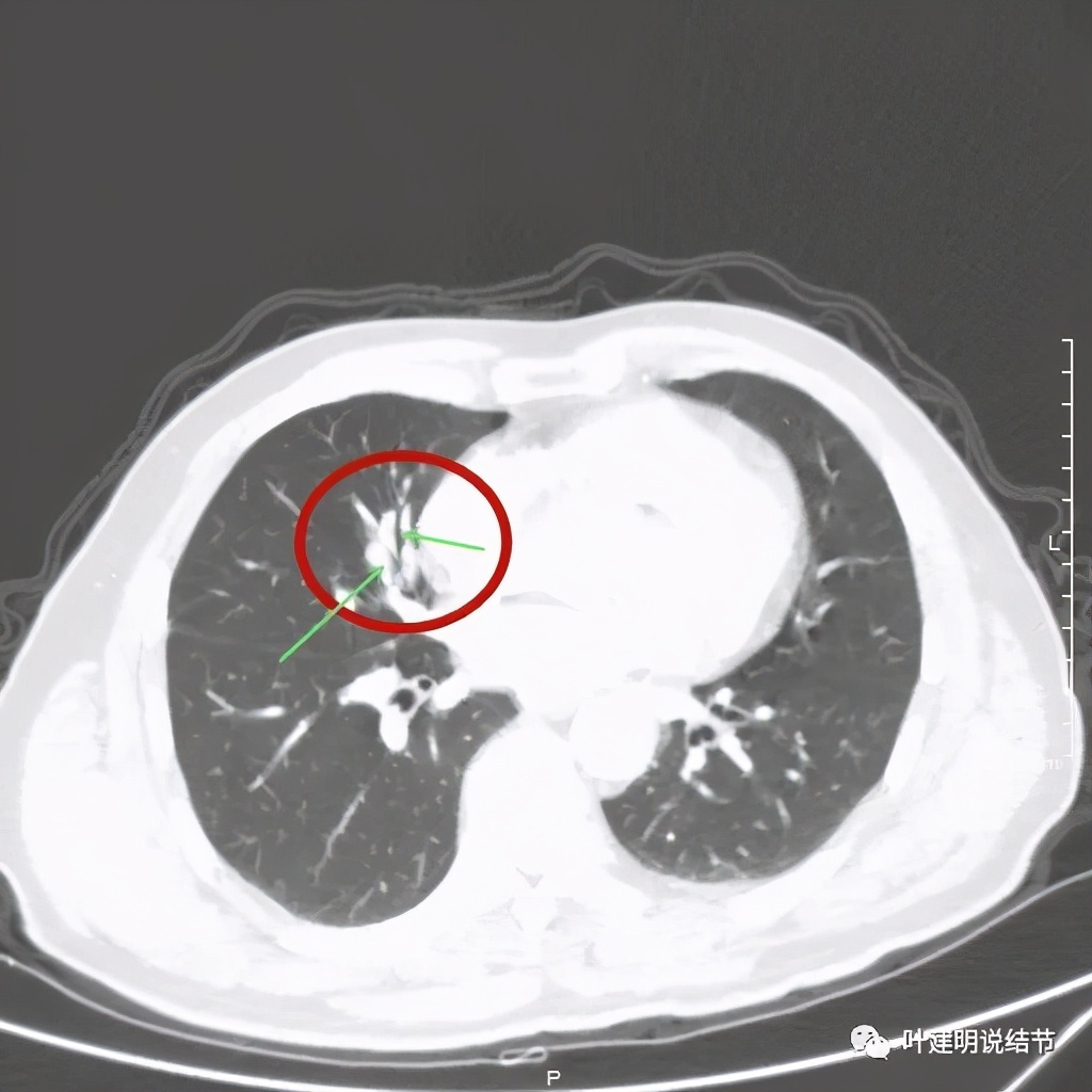 实性结节影要不要紧,实性结节穿刺活检为良性