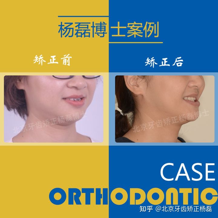 北京牙齿矫正大约要多少钱,北京哪个医院看牙齿矫正比较好