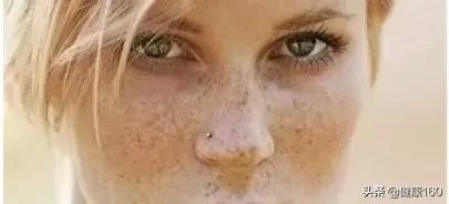 脸上祛斑最简单的方法,想要脸上光滑没瑕疵