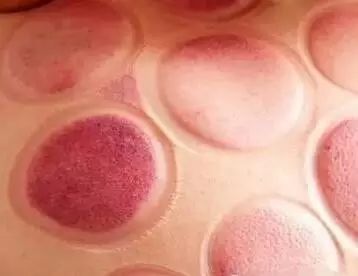 拔罐后为啥有的罐印有的深有的浅,拔罐对人是有好处还是有坏处