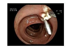 做了肠镜说是结肠息肉，怎么办？