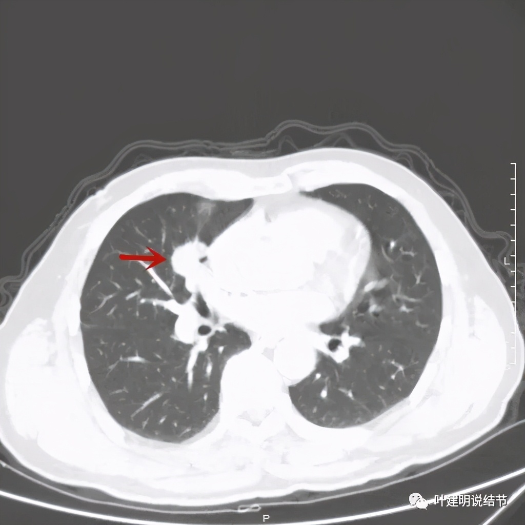 实性结节影要不要紧,实性结节穿刺活检为良性