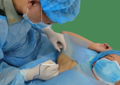 目前最好的腋臭手术方法,做腋臭去除手术挂什么科