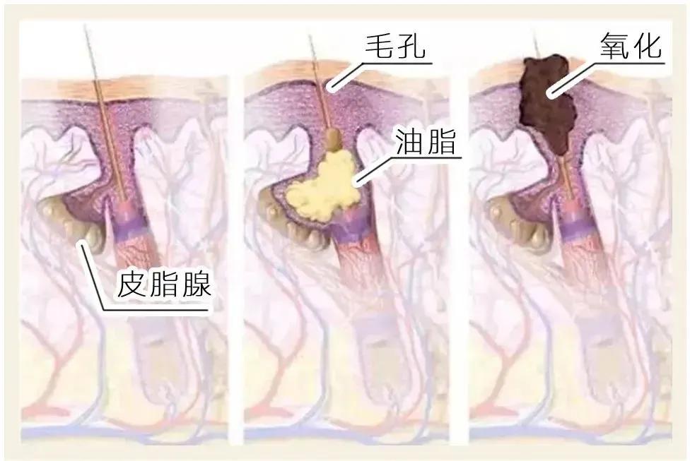 黑头用黑头贴去不掉怎么办,白糖去黑头的正确方法