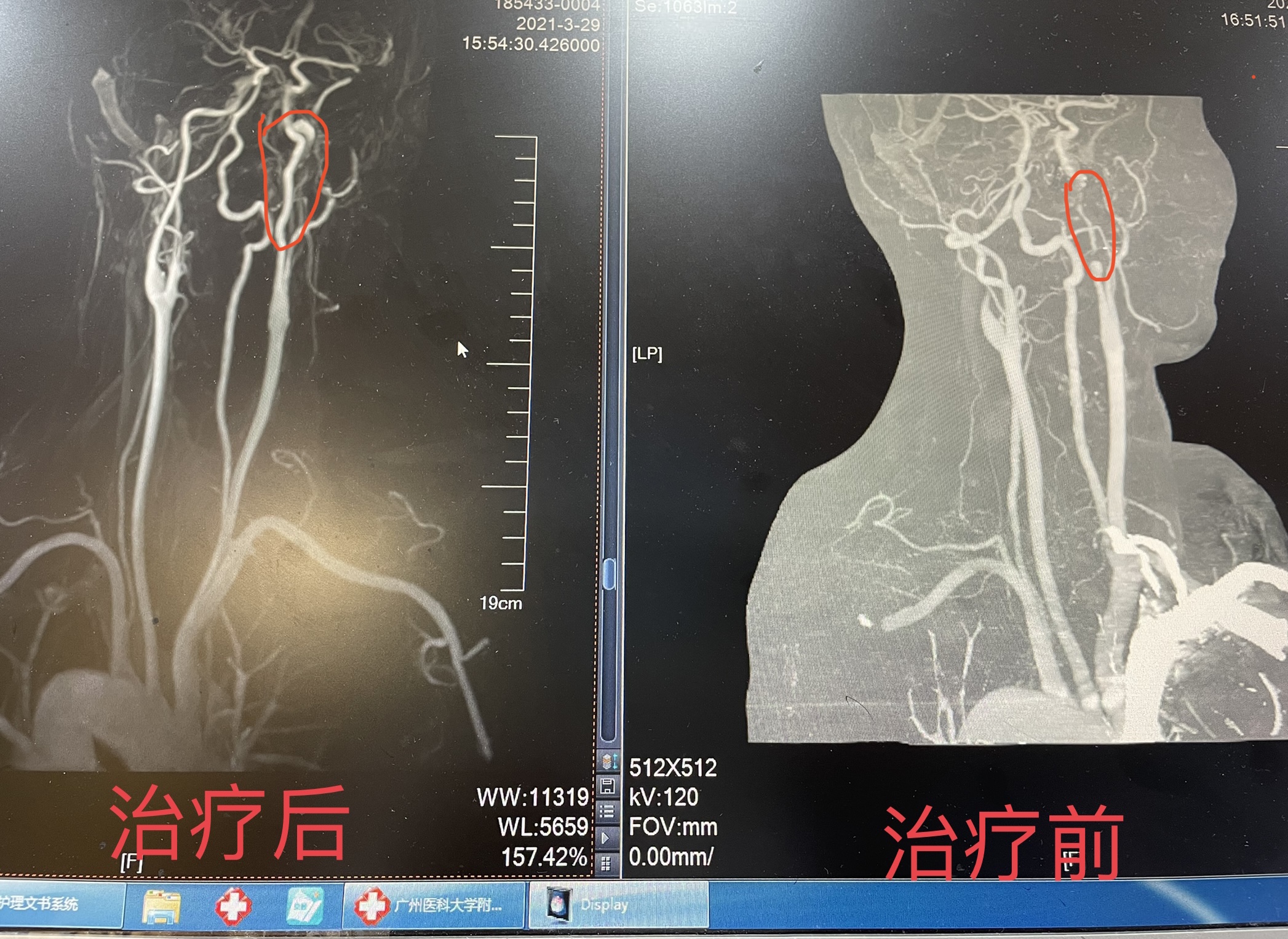 颈动脉狭窄严重可以支架恢复吗,颈动脉狭窄治疗之后心脏会缓解吗