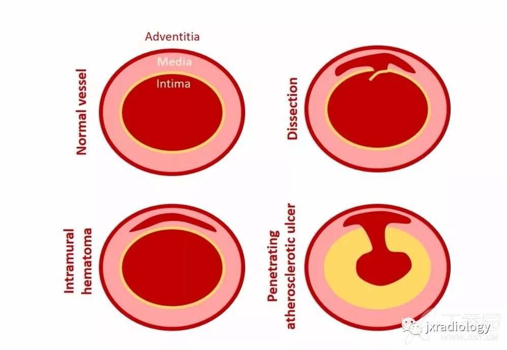 急性主动脉综合征报道,急性主动脉综合征症状