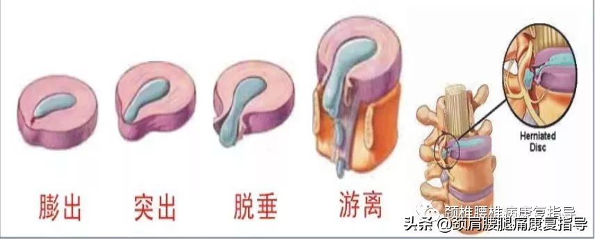 腰椎间盘突出症需要思考的问题,腰椎间盘突出症需要做哪些检查