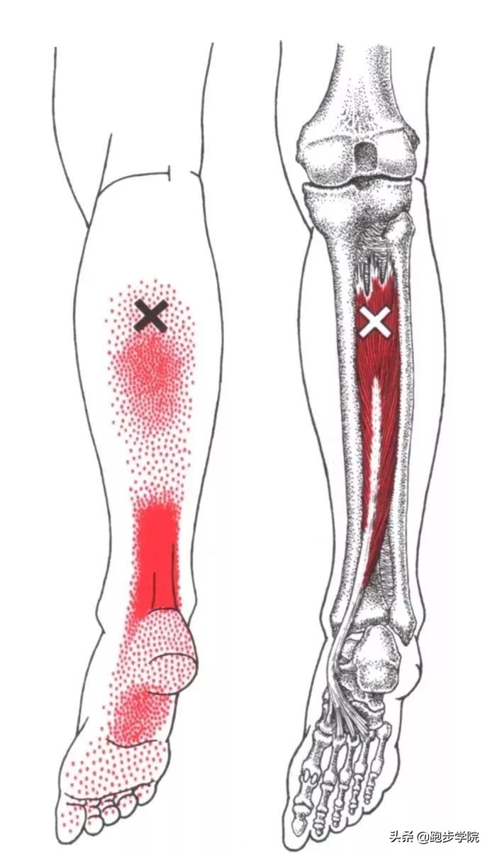 伤害了1/3跑者的胫骨炎,请务必重视起来
