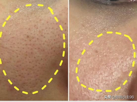 肌肤毛孔粗大出油,油性皮肤毛孔大怎么办