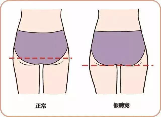 得了梨状肌怎么锻炼,得了梨状肌综合征需要注意什么