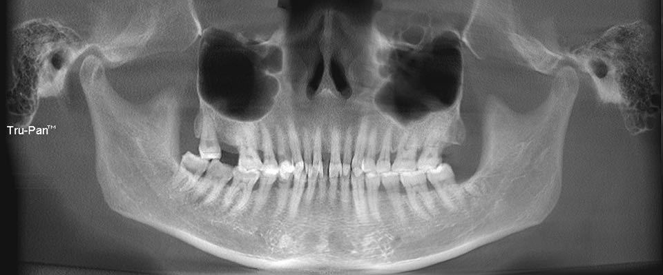 牙周病牙龈萎缩正畸案例,牙周病牙齿已经松动可以正畸吗