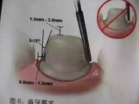 为什么烤瓷牙表面有裂纹,为什么烤瓷牙的牙龈那么黑