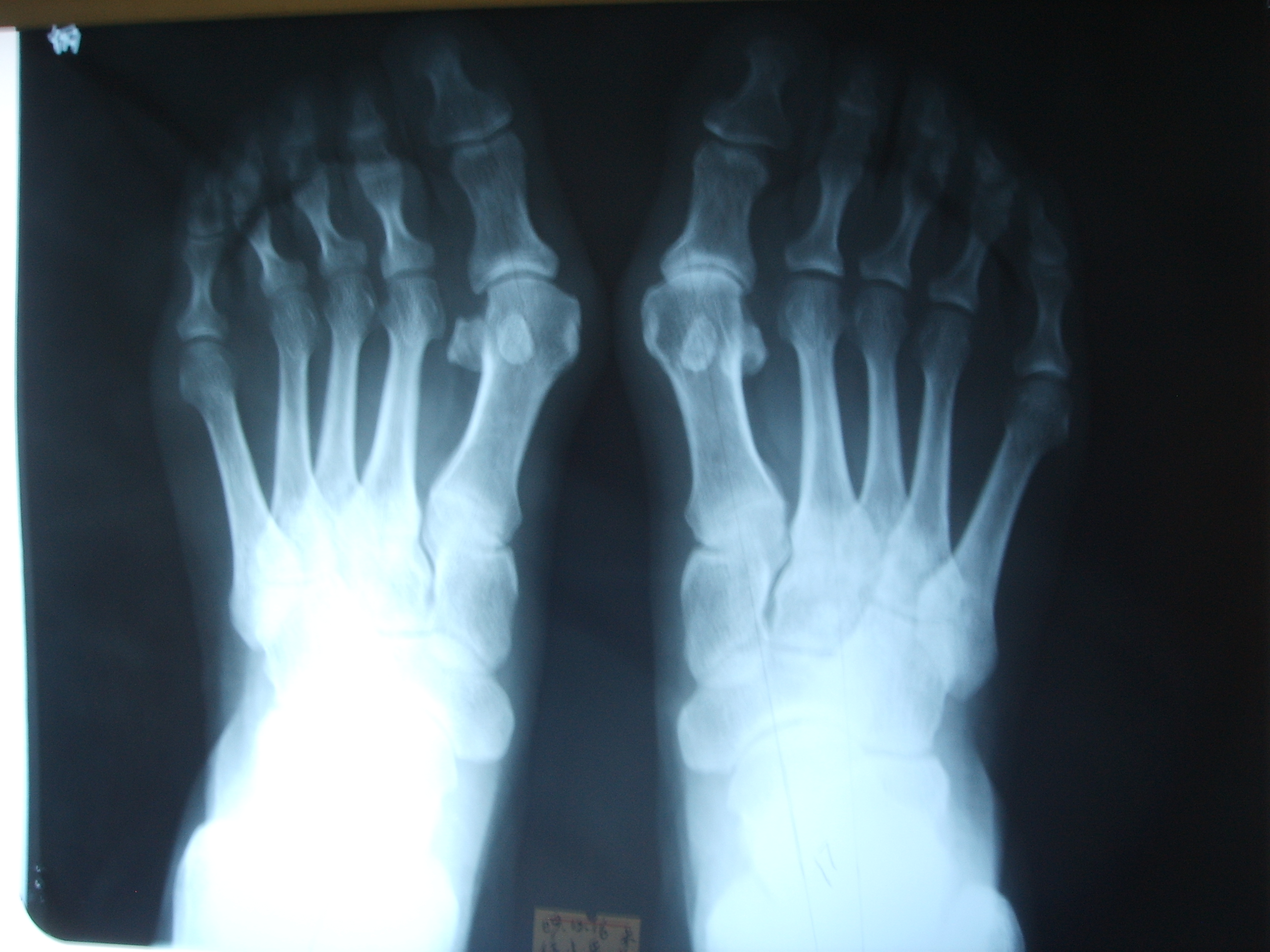 女性大脚骨图片大全,女士大脚骨