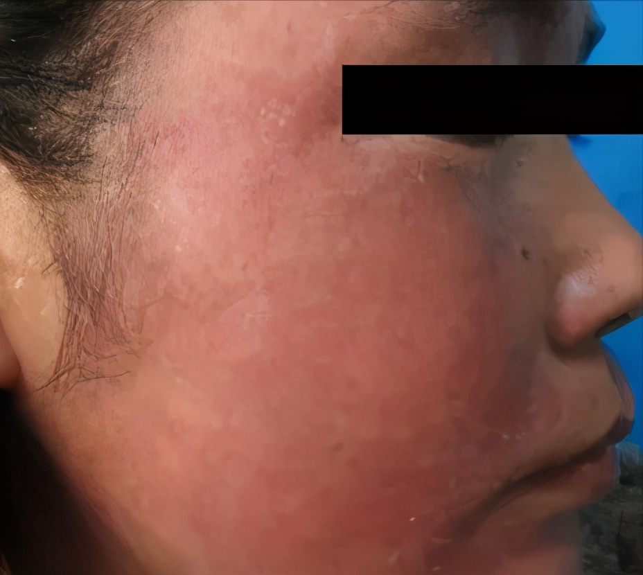 用药了为什么还是有点痒,药物过敏性皮疹痒怎么处理