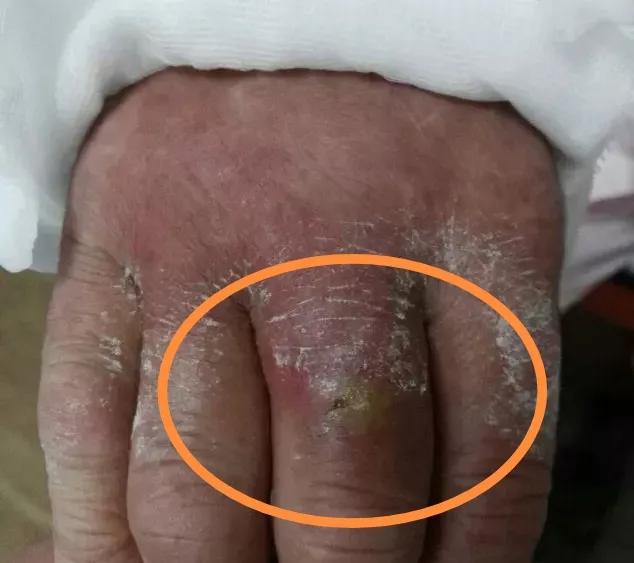 挤痘痘引发脑膜炎几率,挤痘痘会引发囊肿吗