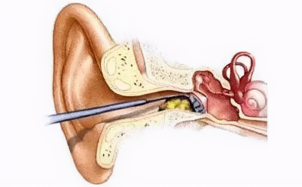 耳朵油油的是病吗,耳朵里面油油的是膜吗