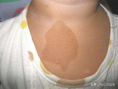 咖啡斑短时间内增大,宝宝身上的牛奶咖啡斑增大了
