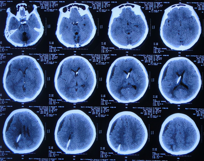 脑出血后脑积水会造成意识不清吗,脑出血后脑积水发高烧危险期多久